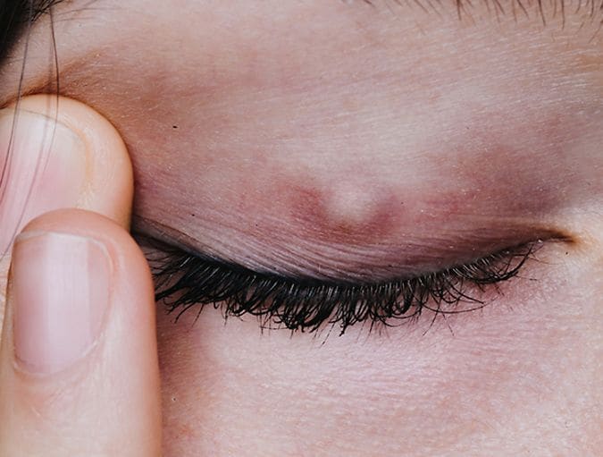 Wearing_contact_lenses_if_you_have_a_chalazion_row_1