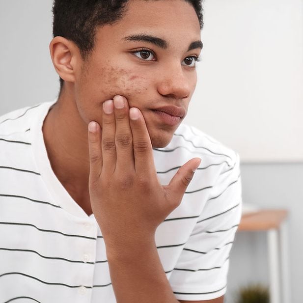 The_Side_Effects_of_Roaccutane_on_Your_Eyes_row_3