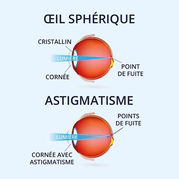 Astigmatism_row_3