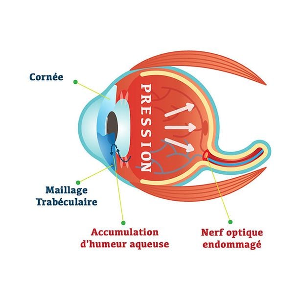 What_is_glaucoma_row_3