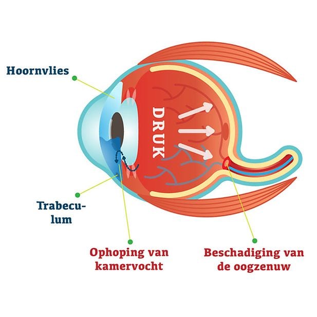 CMS_ooggezondheid_wat-is-glaucoom_BENL_inline_1