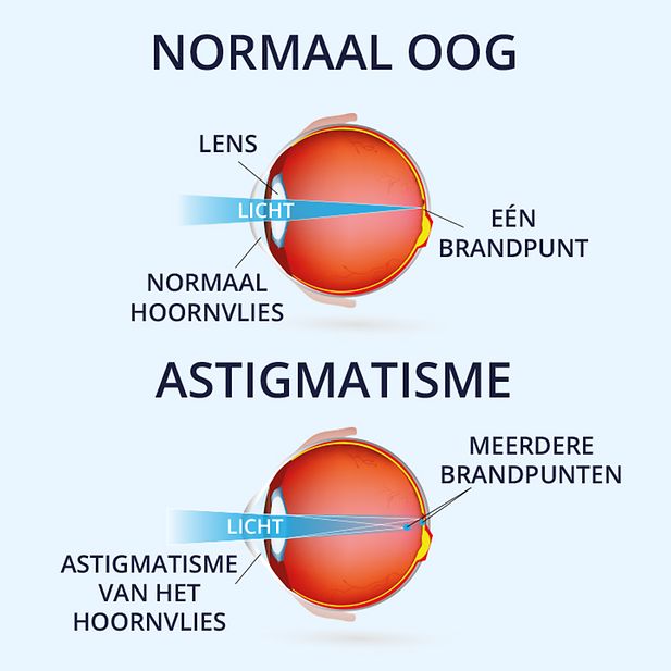 Illustratie van een oog met en zonder astigmatisme